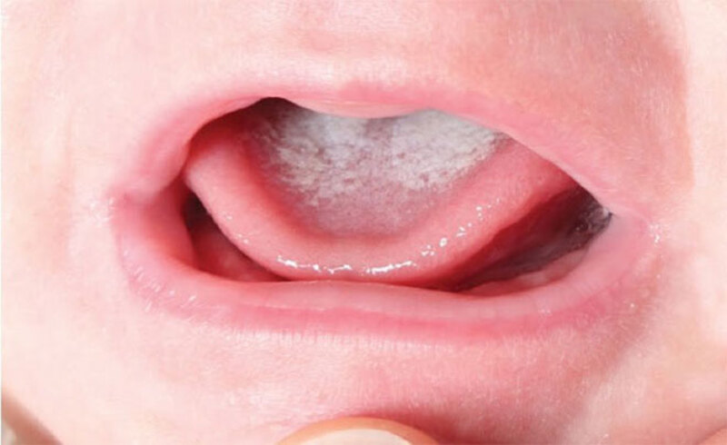 Tưa lưỡi là tên gọi phổ biến của bệnh nhiễm trùng miệng do sự phát triển