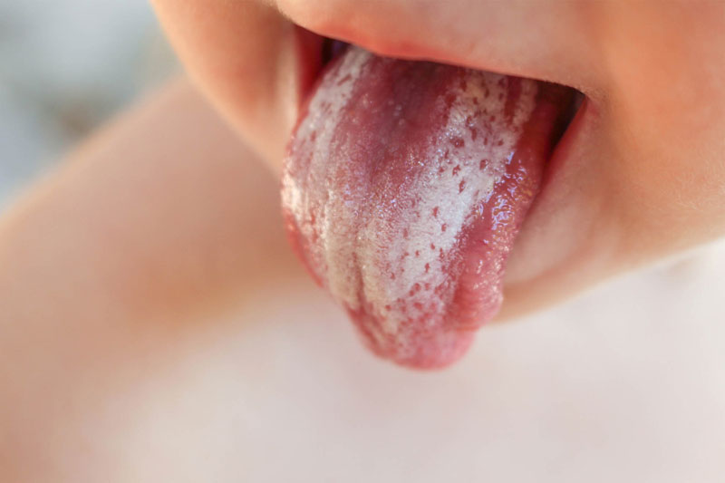 Có rất nhiều nguyên nhân khiến trẻ bị tưa lưỡi
