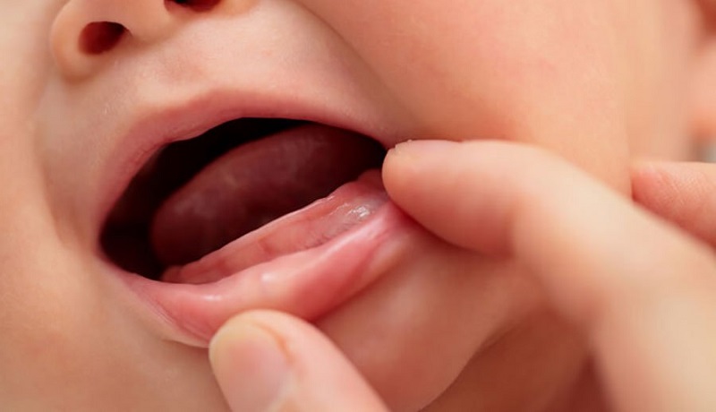 Có rất nhiều lý do dẫn đến tình trạng chậm mọc răng ở trẻ