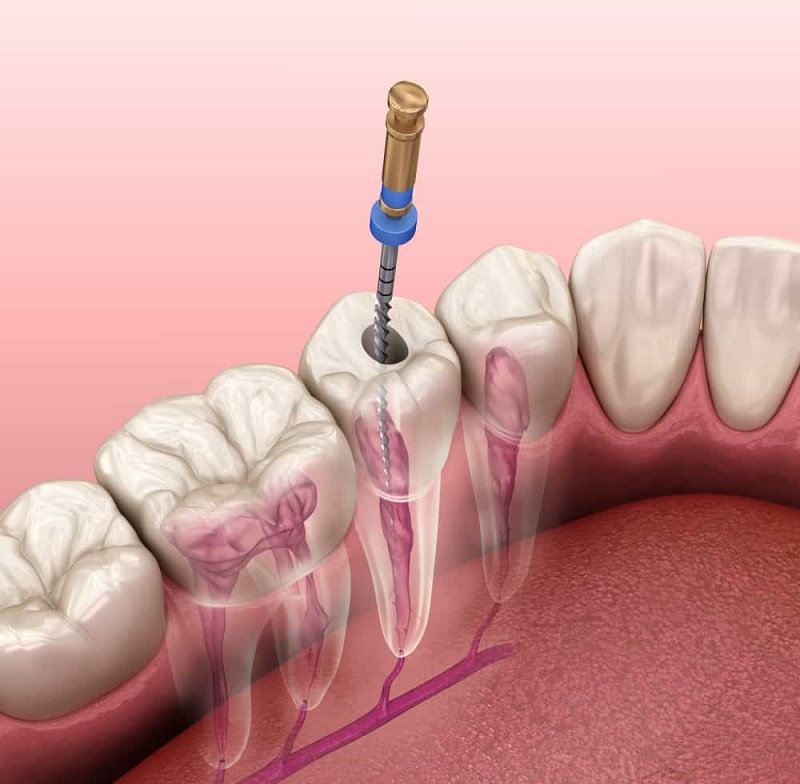 Trám ống tủy răng là phương pháp được bác sĩ chỉ định cho bệnh nhân bị viêm lợi hôi miệng nghiêm trọng