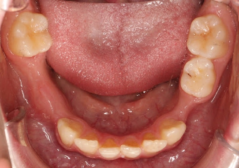Mất răng là biến chứng đáng tiếc của viêm lợi trùm