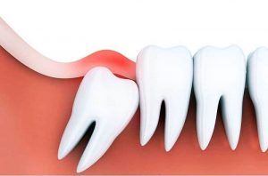 Dấu hiệu nhận biết và điều trị viêm lợi trùm răng khôn là một trong những bệnh lý gặp phải trong quá trình mọc răng khôn