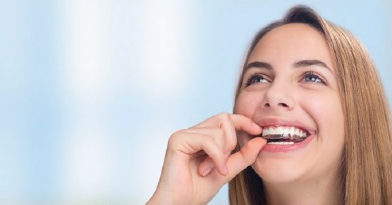 Các loại niềng răng trong suốt và lưu ý cần biết