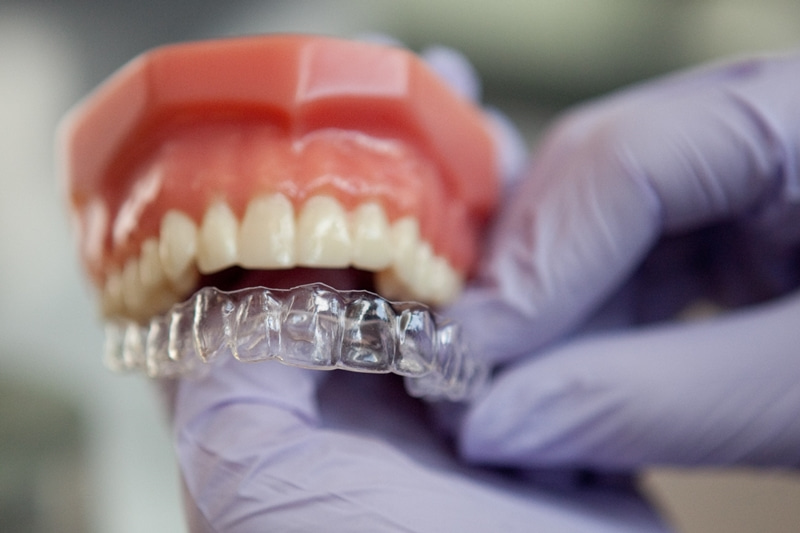 Giá niềng răng khấp khểnh không mắc cài thường giao động từ 70 - 120 triệu.
