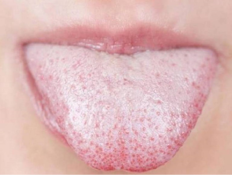 Nếu trên lưỡi xuất hiện cặn trắng thì đây có thể là triệu chứng của hôi miệng dạ dày