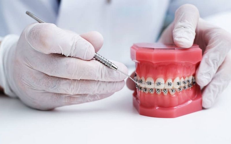 Điều kiện và các kỹ thuật chỉnh nha không đúng là một nguyên nhân gây ra tình trạng hóp má sau niềng răng