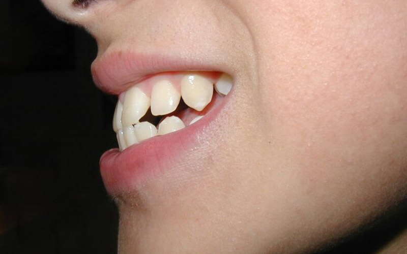 Bệnh nhân bị răng hô nếu muốn niềng răng cần nhổ răng khôn để tạo không gian dịch chuyển