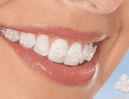Niềng răng mắc cài sứ dây trong có thực sự hiệu quả không?