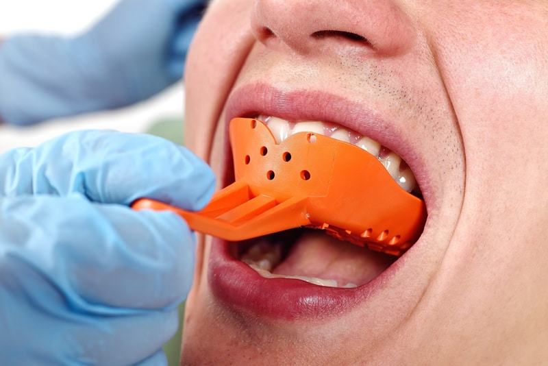 Trước khi tiến hành gắn mắc cài, nha sĩ sẽ thực hiện lấy dấu răng để chuyển đến bộ phận thiết kế mắc cài.