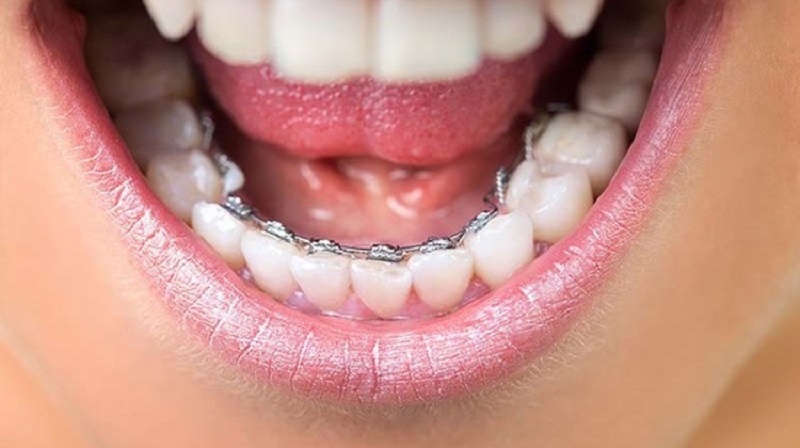 Niềng răng mặt trong có tính thẩm mỹ cao hơn niềng răng mắc cài truyền thống nhưng khó vệ sinh răng hơn