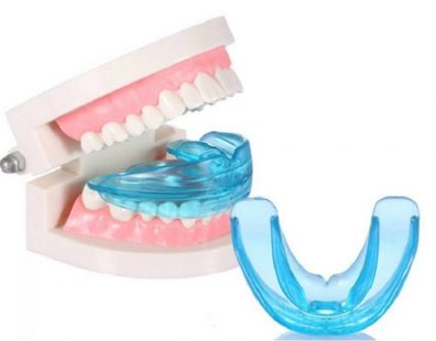 Niềng răng Trainer tại nhà có thực sự hiệu quả không?