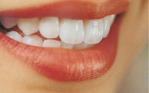 Răng hô nhẹ cũng là một khuyết điểm rất nhiều người châu Á gặp phải