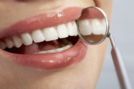 Bọc răng Composite là gì? Có nên thực hiện hay không?