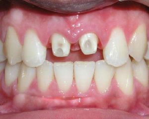Bọc răng sứ bị hở có thể trở thành mối rủi ro đáng lo ngại