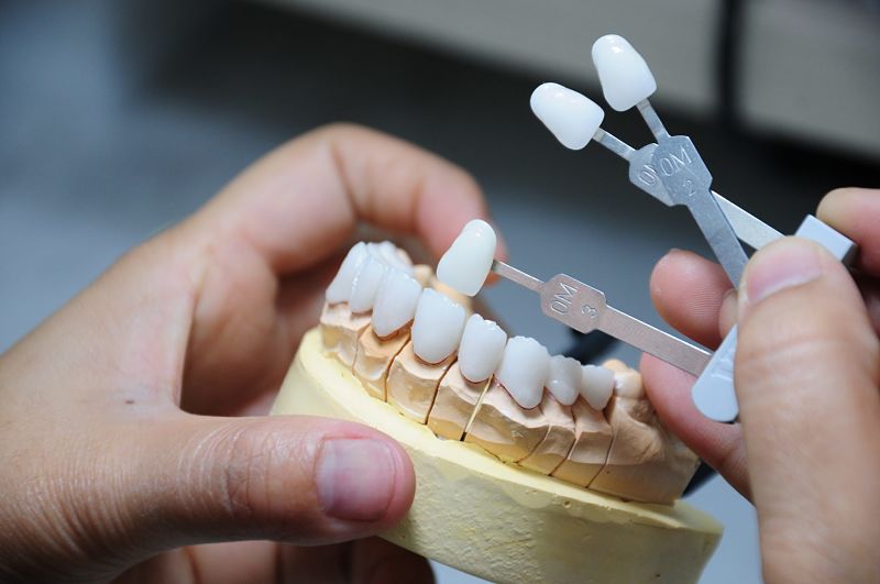 Bác sĩ sẽ lấy dấu răng và gửi đến phòng Lab để chế tác răng sứ