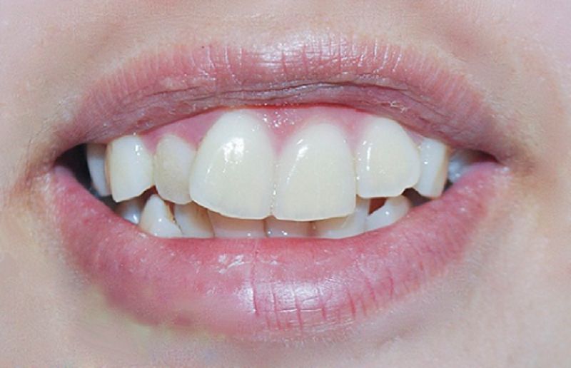 Bọc răng sứ cho răng hô là phương pháp khắc phục tình trạng hô răng hiệu quả