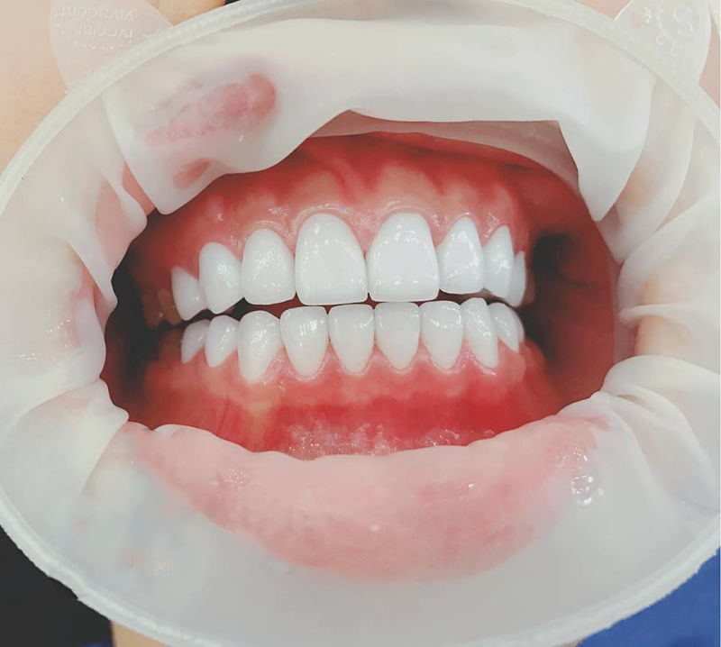 Răng sứ Zirconia được chuyên gia khuyên dùng khi bọc răng sứ cho răng hô