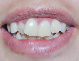 Bọc răng sứ cho răng hô có nên không? Quy trình và chi phí ra sao? 