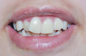 Bọc răng sứ cho răng hô có nên không? Quy trình và chi phí ra sao? 