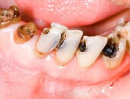 Bọc răng sứ cho răng sâu: Quy trình, chi phí