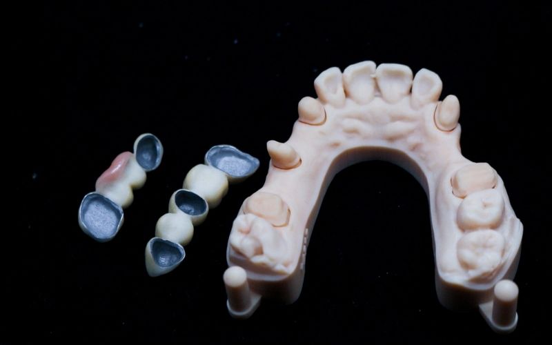 Răng sứ kim loại có phần sườn làm từ vật liệu kim loại
