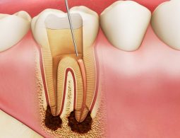 Bọc răng sứ có phải lấy tủy không là thắc mắc của rất nhiều độc giả