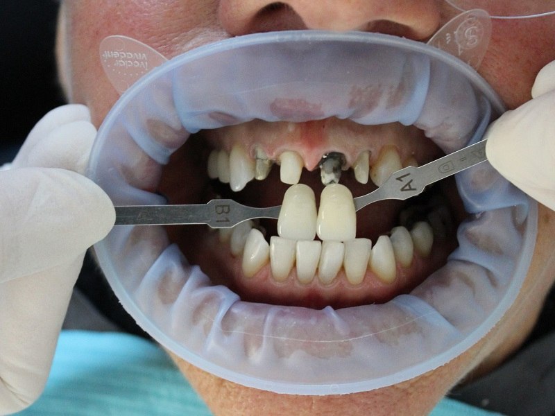 Quy trình bọc răng sứ có lấy tủy
