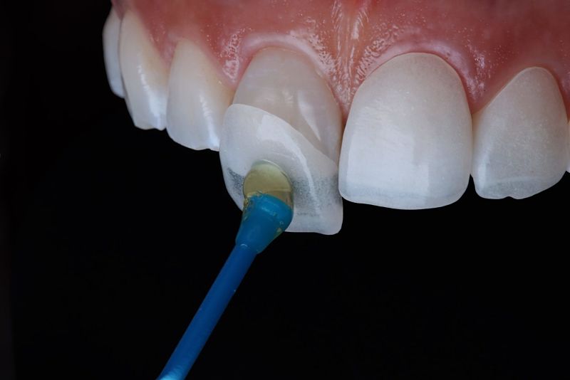 Chi phí bọc răng sứ phụ thuộc nhiều vào chất liệu bọc răng