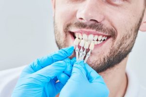 Những yếu tố tác động tới thời gian bọc răng sứ