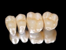 Bọc răng sứ Titan: Một số thông tin bạn cần biết