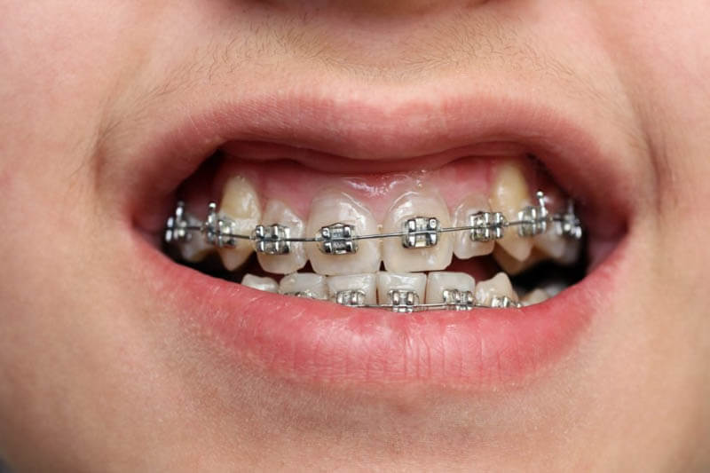 Niềng răng khểnh là hình thức chỉnh nha được áp dụng nhiều hiện nay
