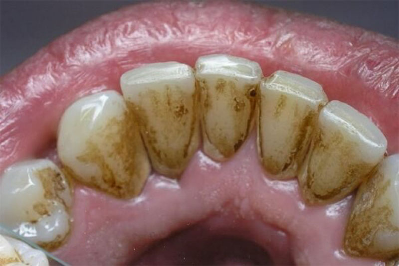 Cao răng chính là những mảng bám có màu trắng ngà trên răng