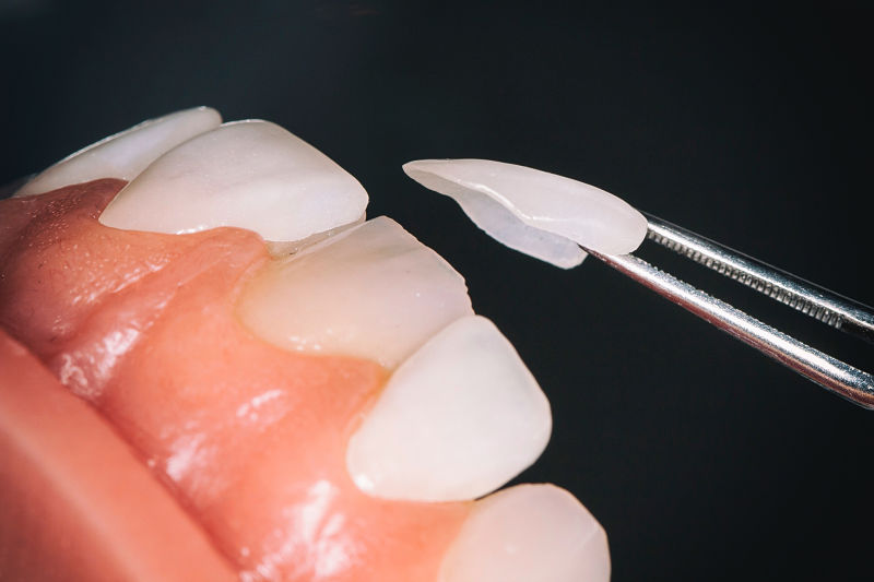 Dán răng sứ là phương pháp thẩm mỹ nha khoa hiện đại