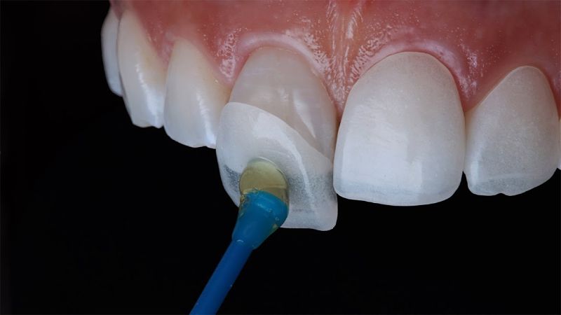 Mặt dán sứ thẩm mỹ có tác dụng bảo vệ răng khỏi các vi khuẩn