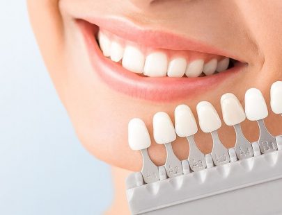 Dán răng sứ veneer có tốt không?