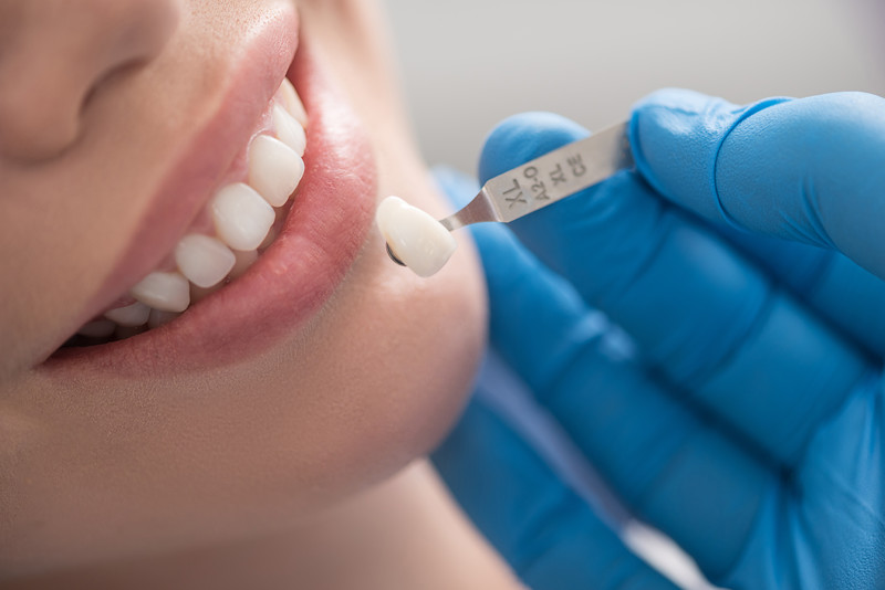 Phương pháp dán răng sứ Veneer thường dao động từ 5 - 10 triệu đồng