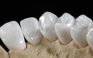 Zirconia là loại răng sứ đặc biệt, đảm bảo an toàn tuyệt đối cho sức khỏe răng miệng
