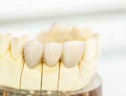 Vai trò của chế độ chăm sóc răng sau khi bọc sứ