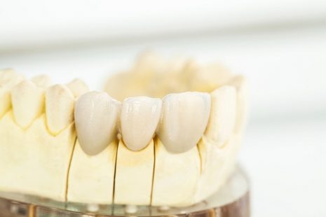 Vai trò của chế độ chăm sóc răng sau khi bọc sứ