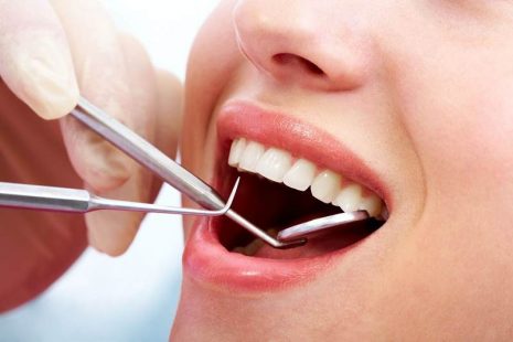 Lấy cao răng có hại không? [Giải đáp chi tiết]