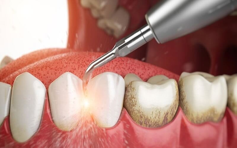 Bệnh viện Răng hàm mặt Trung ương là địa chỉ lấy cao răng an toàn