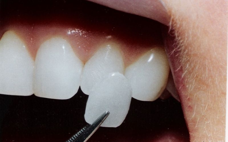 Giá mặt dán sứ Veneer thường cao hơn so với chi phí bọc răng sứ