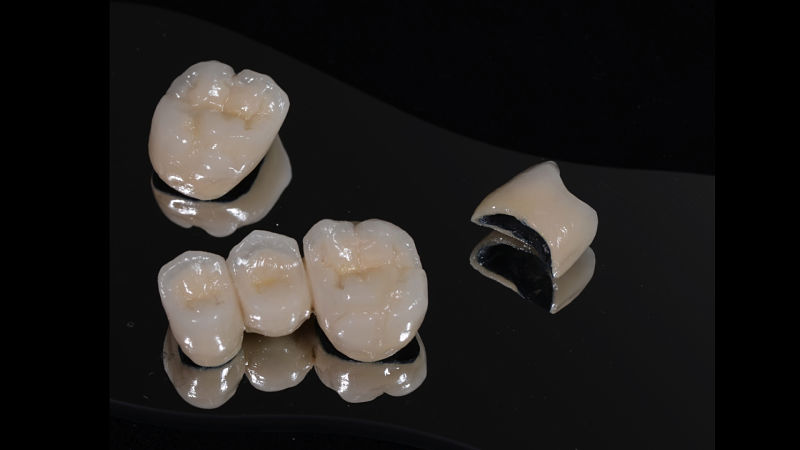 Răng sứ Titan có độ bền cao, chức năng nhai tốt