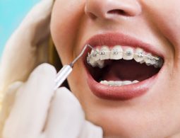 [Giải đáp chi triết] Có nên niềng răng nhổ răng số 3 hay không?
