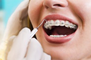 [Giải đáp chi triết] Có nên niềng răng nhổ răng số 3 hay không?
