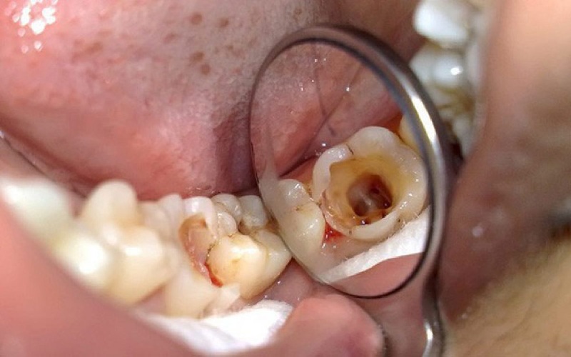 Nếu răng số 6 bị sâu nghiêm trọng thì cần phải nhổ bỏ