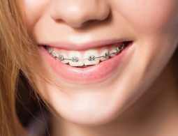Niềng răng nhổ răng số 6 có đau không, bị ảnh hưởng gì không?