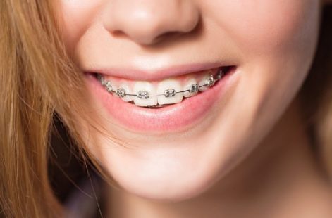 Niềng răng nhổ răng số 6 có đau không, bị ảnh hưởng gì không?