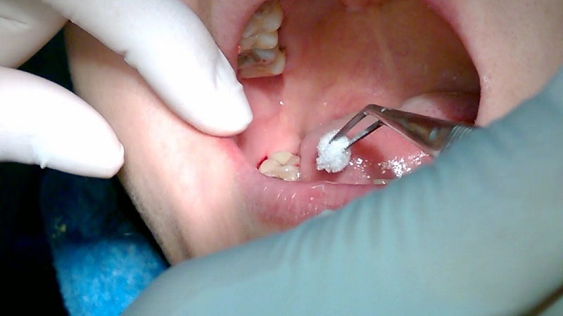 Niềng răng nhổ răng số 8 sẽ được áp dụng một số trường hợp được bác sĩ chỉ định