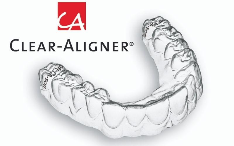 Clear Aligner là phương pháp sử dụng khay niềng trong suốt
